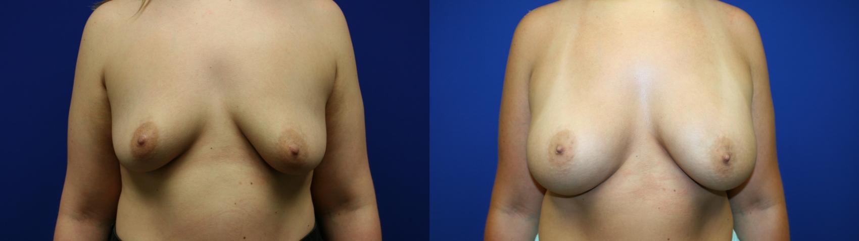 Breast Augmentation Case 77 Before & After Front | Downers Grove, IL | Dr. Sandeep Jejurikar