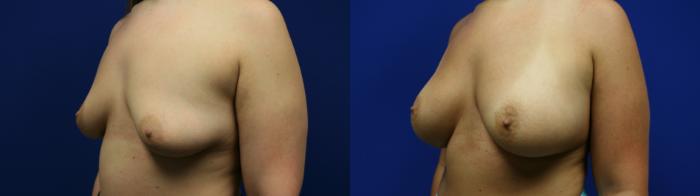 Breast Augmentation Case 77 Before & After Left Oblique | Downers Grove, IL | Dr. Sandeep Jejurikar