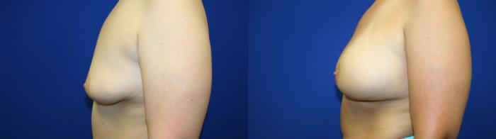 Breast Augmentation Case 77 Before & After Left Side | Downers Grove, IL | Dr. Sandeep Jejurikar