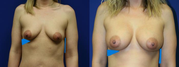 Breast Augmentation Case 86 Before & After Front | Downers Grove, IL | Dr. Sandeep Jejurikar