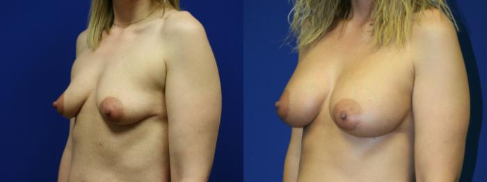 Breast Augmentation Case 86 Before & After Left Oblique | Downers Grove, IL | Dr. Sandeep Jejurikar