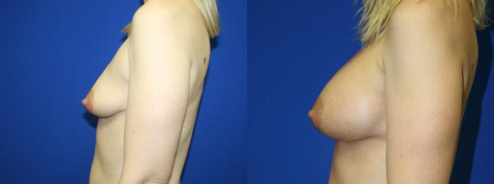 Breast Augmentation Case 86 Before & After Left Side | Downers Grove, IL | Dr. Sandeep Jejurikar