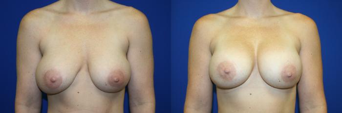 Breast Augmentation Case 92 Before & After Front | Downers Grove, IL | Dr. Sandeep Jejurikar