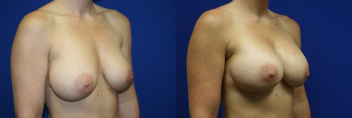 Breast Augmentation Case 92 Before & After Right Oblique | Downers Grove, IL | Dr. Sandeep Jejurikar