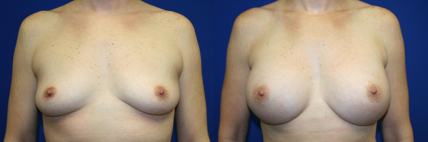 Breast Augmentation Case 94 Before & After Front | Downers Grove, IL | Dr. Sandeep Jejurikar