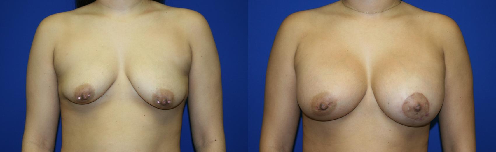 Breast Augmentation Case 97 Before & After Front | Downers Grove, IL | Dr. Sandeep Jejurikar