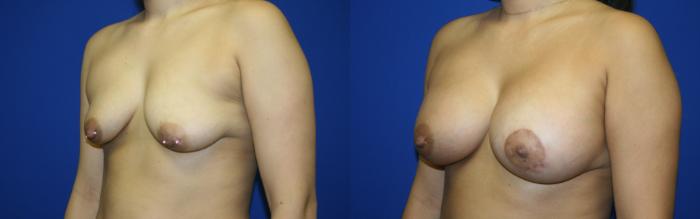 Breast Lift Case 97 Before & After Left Oblique | Downers Grove, IL | Dr. Sandeep Jejurikar