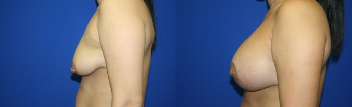 Breast Augmentation Case 97 Before & After Left Side | Downers Grove, IL | Dr. Sandeep Jejurikar