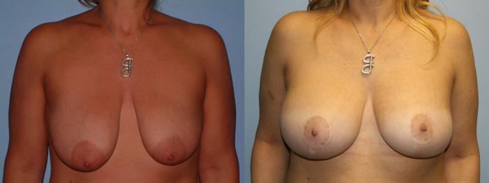 Breast Lift Case 1 Before & After View #1 | Downers Grove, IL | Dr. Sandeep Jejurikar