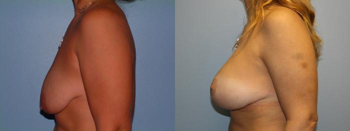 Breast Lift Case 1 Before & After View #2 | Downers Grove, IL | Dr. Sandeep Jejurikar