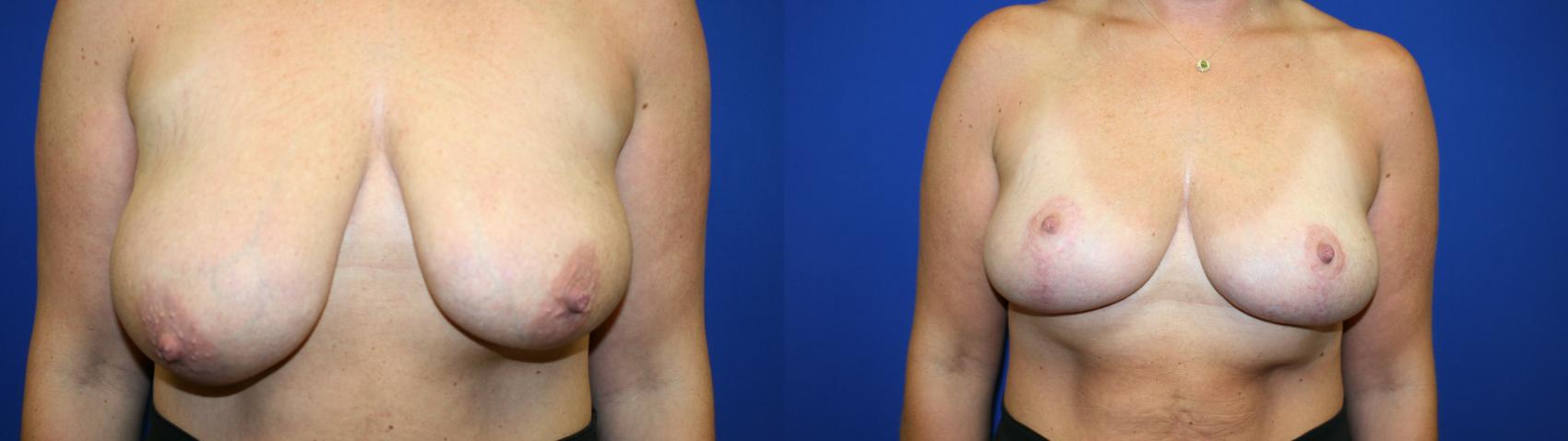 Breast Lift Case 126 Before & After Front | Downers Grove, IL | Dr. Sandeep Jejurikar