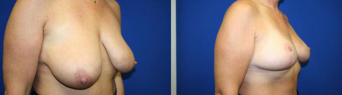 Breast Lift Case 126 Before & After Right Oblique | Downers Grove, IL | Dr. Sandeep Jejurikar