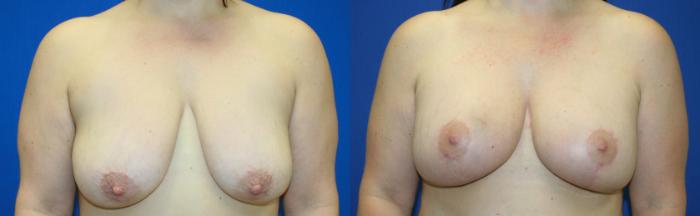 Breast Lift Case 43 Before & After View #1 | Downers Grove, IL | Dr. Sandeep Jejurikar