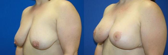 Breast Lift Case 43 Before & After View #3 | Downers Grove, IL | Dr. Sandeep Jejurikar