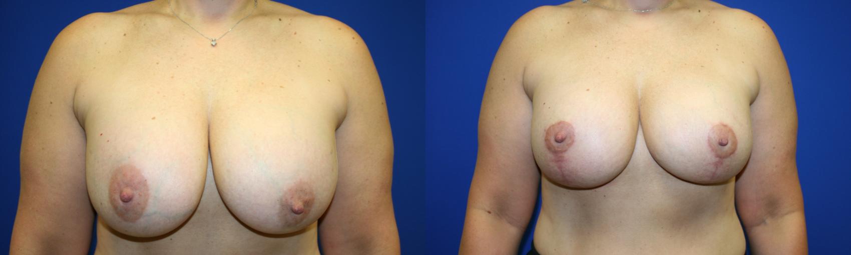 Breast Lift Case 75 Before & After Front | Downers Grove, IL | Dr. Sandeep Jejurikar