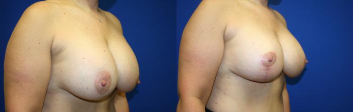 Breast Augmentation Case 75 Before & After Right Oblique | Downers Grove, IL | Dr. Sandeep Jejurikar