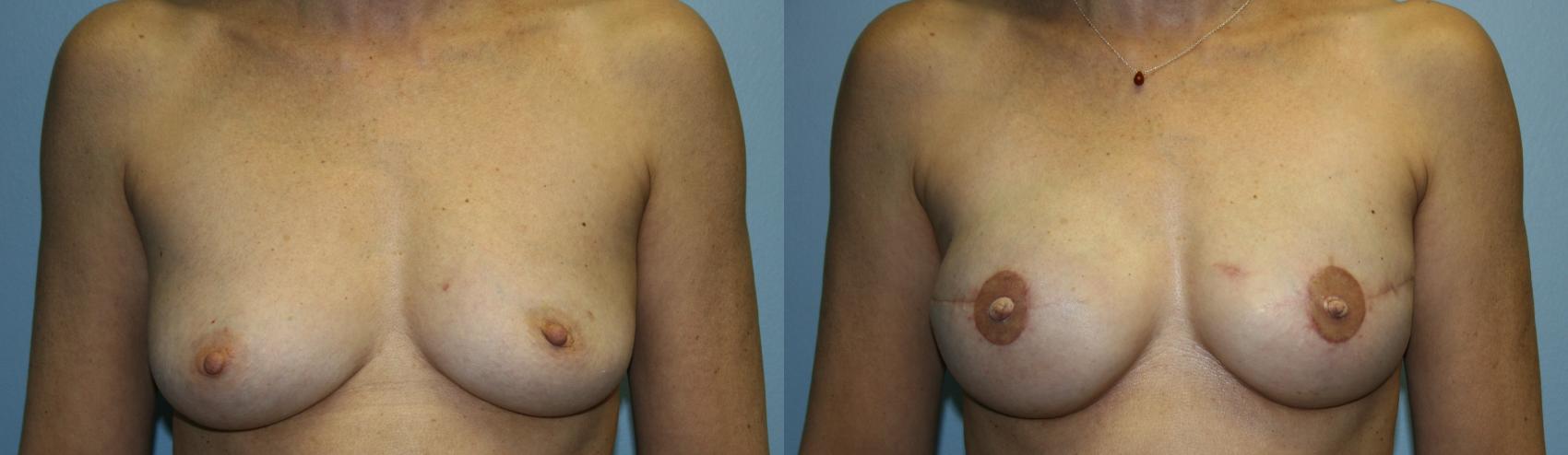 Breast Reconstruction Case 50 Before & After View #1 | Downers Grove, IL | Dr. Sandeep Jejurikar