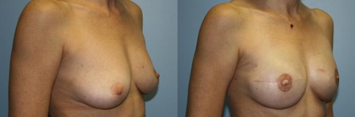 Breast Reconstruction Case 50 Before & After View #2 | Downers Grove, IL | Dr. Sandeep Jejurikar