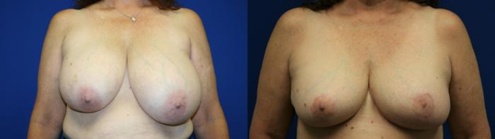 Breast Reduction Case 100 Before & After Front | Downers Grove, IL | Dr. Sandeep Jejurikar