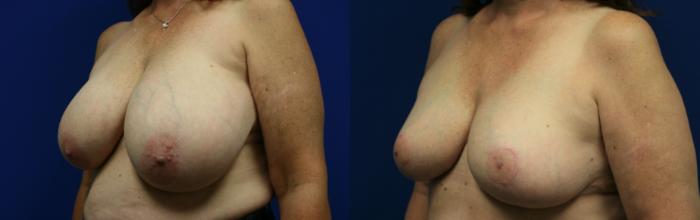 Breast Reduction Case 100 Before & After Left Oblique | Downers Grove, IL | Dr. Sandeep Jejurikar