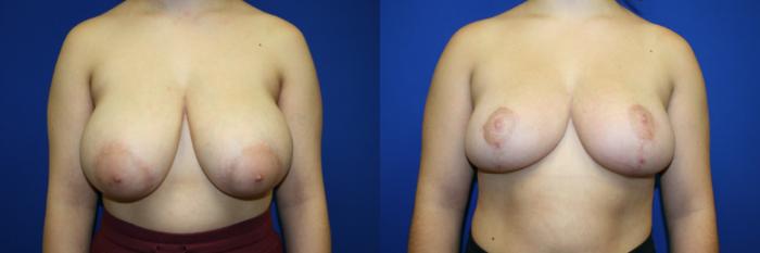 Breast Reduction Case 101 Before & After Front | Downers Grove, IL | Dr. Sandeep Jejurikar