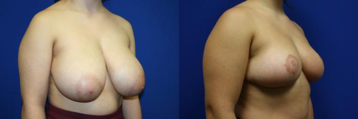 Breast Reduction Case 101 Before & After Right Oblique | Downers Grove, IL | Dr. Sandeep Jejurikar
