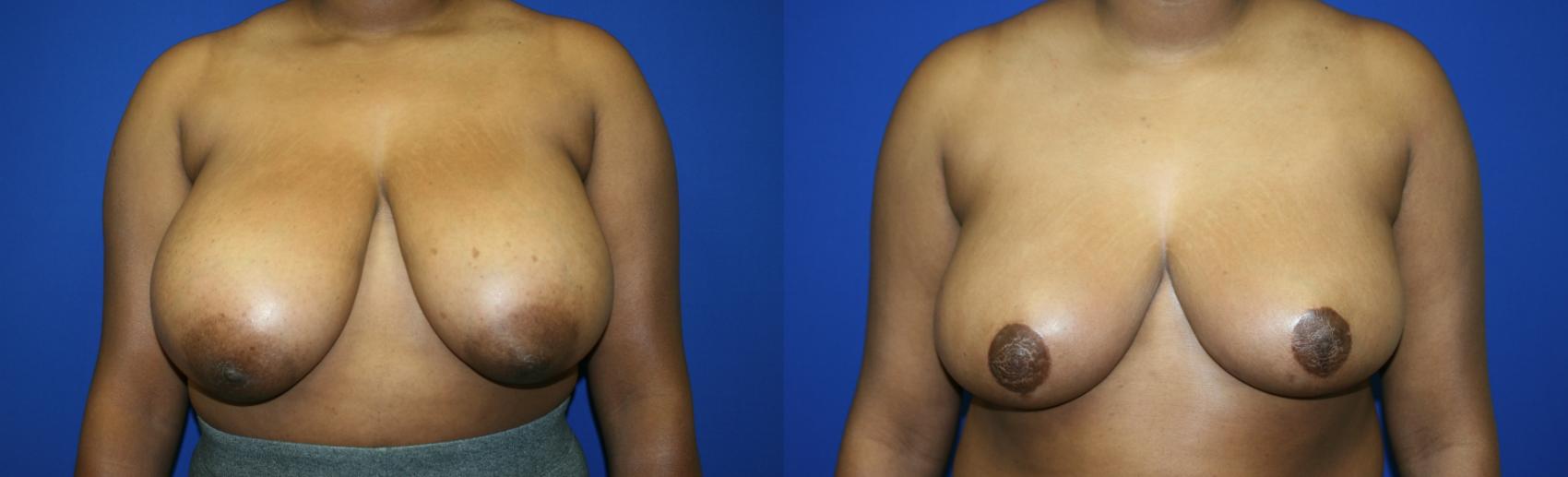 Breast Reduction Case 106 Before & After Front | Downers Grove, IL | Dr. Sandeep Jejurikar