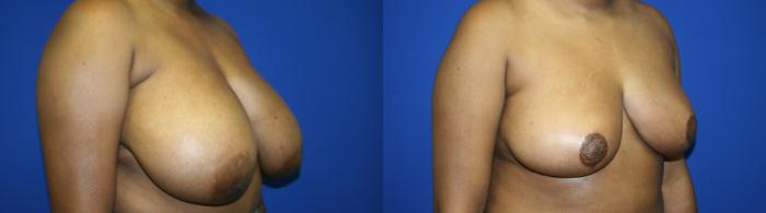 Breast Reduction Case 106 Before & After Right Oblique | Downers Grove, IL | Dr. Sandeep Jejurikar