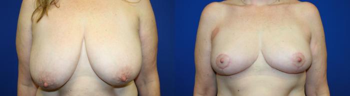 Breast Reduction Case 108 Before & After Front | Downers Grove, IL | Dr. Sandeep Jejurikar