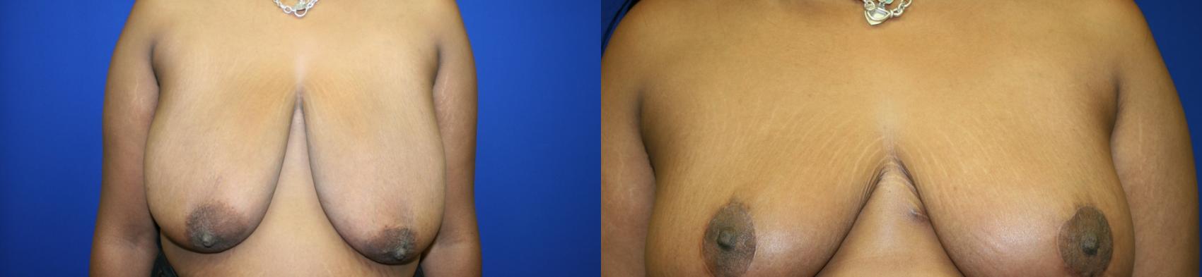 Breast Reduction Case 111 Before & After Front | Downers Grove, IL | Dr. Sandeep Jejurikar