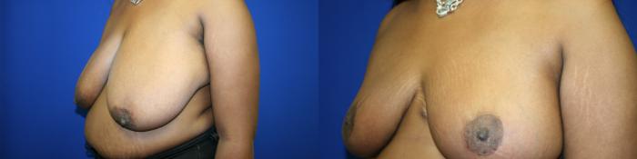 Breast Reduction Case 111 Before & After Left Oblique | Downers Grove, IL | Dr. Sandeep Jejurikar