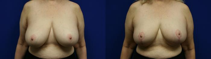 Breast Reduction Case 112 Before & After Front | Downers Grove, IL | Dr. Sandeep Jejurikar