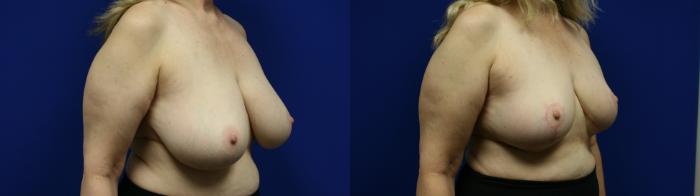 Breast Reduction Case 112 Before & After Right Oblique | Downers Grove, IL | Dr. Sandeep Jejurikar