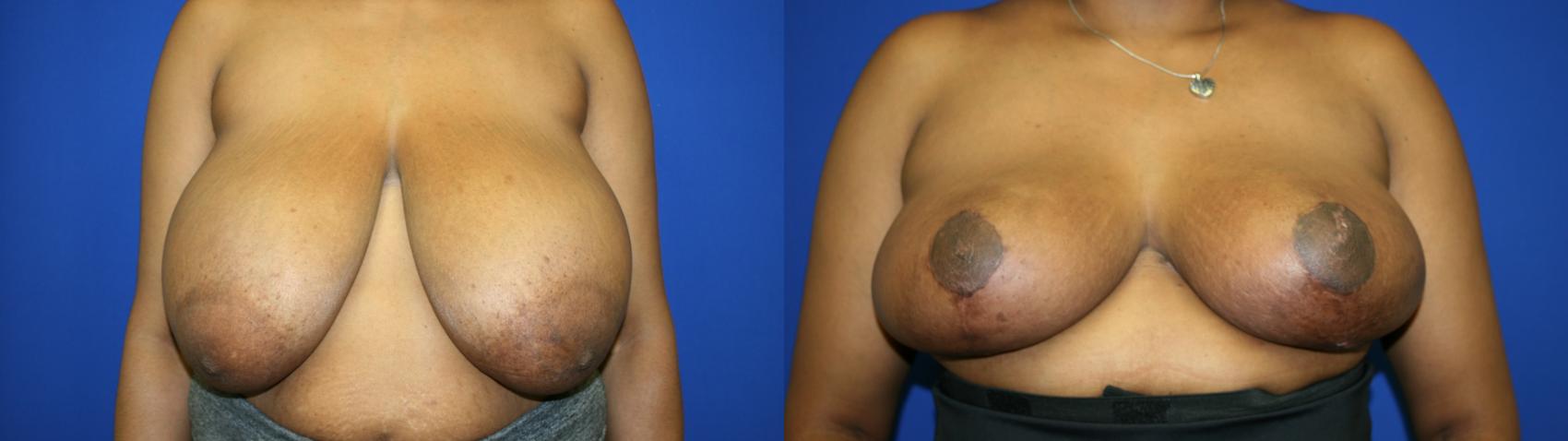 Breast Reduction Case 118 Before & After Front | Downers Grove, IL | Dr. Sandeep Jejurikar