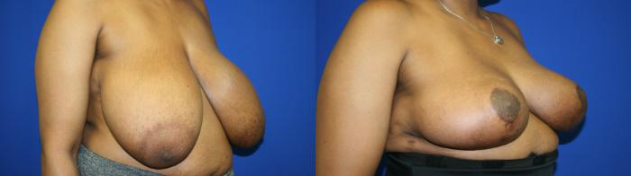 Breast Reduction Case 118 Before & After Right Oblique | Downers Grove, IL | Dr. Sandeep Jejurikar