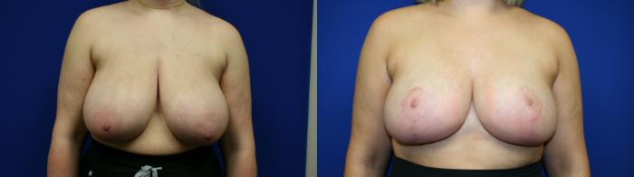 Breast Reduction Case 120 Before & After Front | Downers Grove, IL | Dr. Sandeep Jejurikar