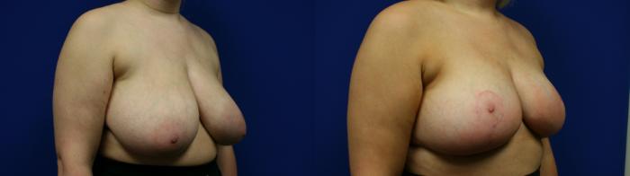 Breast Reduction Case 120 Before & After Right Oblique | Downers Grove, IL | Dr. Sandeep Jejurikar