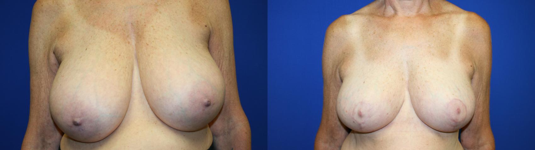 Breast Reduction Case 130 Before & After Front | Downers Grove, IL | Dr. Sandeep Jejurikar