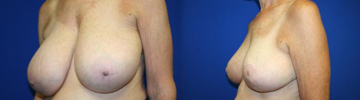 Breast Reduction Case 130 Before & After Left Oblique | Downers Grove, IL | Dr. Sandeep Jejurikar