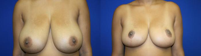 Breast Reduction Case 131 Before & After Front | Downers Grove, IL | Dr. Sandeep Jejurikar