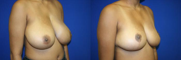 Breast Reduction Case 131 Before & After Right Oblique | Downers Grove, IL | Dr. Sandeep Jejurikar