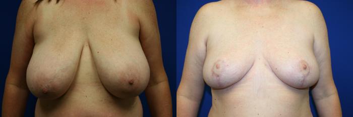 Breast Reduction Case 135 Before & After Front | Downers Grove, IL | Dr. Sandeep Jejurikar