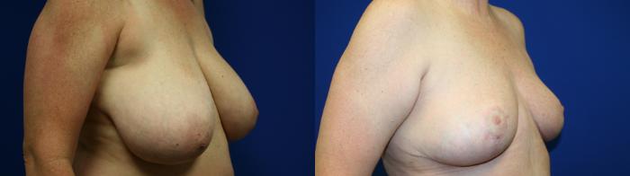 Breast Reduction Case 135 Before & After Right Oblique | Downers Grove, IL | Dr. Sandeep Jejurikar