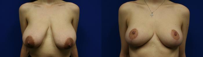 Breast Reduction Case 140 Before & After Front | Downers Grove, IL | Dr. Sandeep Jejurikar