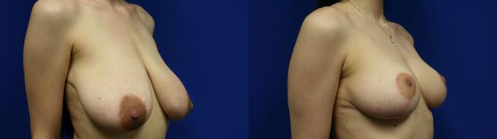 Breast Reduction Case 140 Before & After Right Oblique | Downers Grove, IL | Dr. Sandeep Jejurikar