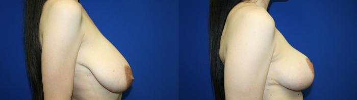 Breast Reduction Case 140 Before & After Right Side | Downers Grove, IL | Dr. Sandeep Jejurikar