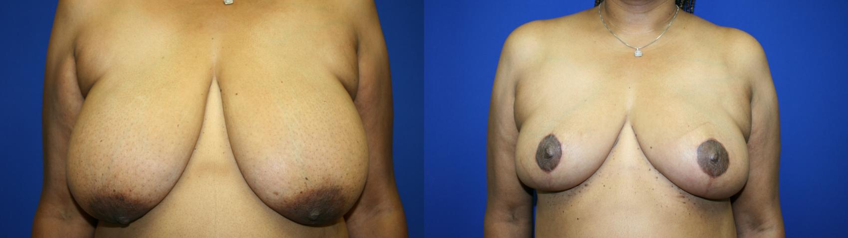 Breast Reduction Case 141 Before & After Front | Downers Grove, IL | Dr. Sandeep Jejurikar