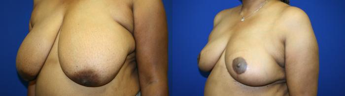 Breast Reduction Case 141 Before & After Left Oblique | Downers Grove, IL | Dr. Sandeep Jejurikar