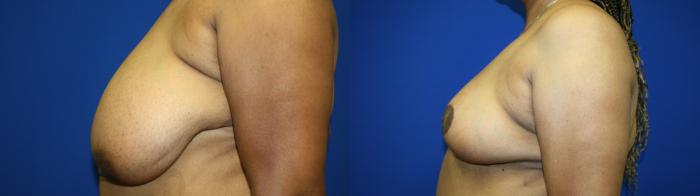 Breast Reduction Case 141 Before & After Left Side | Downers Grove, IL | Dr. Sandeep Jejurikar