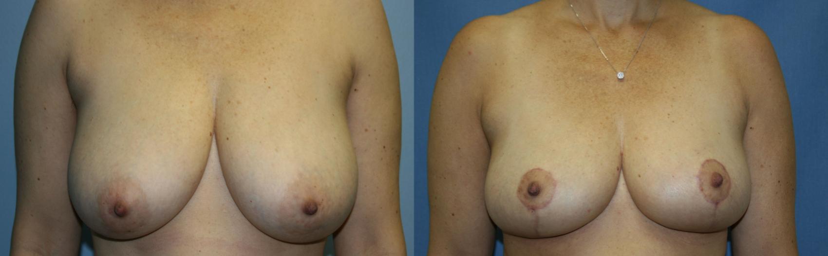 Breast Reduction Case 32 Before & After View #1 | Downers Grove, IL | Dr. Sandeep Jejurikar